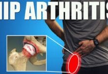 Reclaim Joint Health: Beat Hip Pain & Boost Mobility!